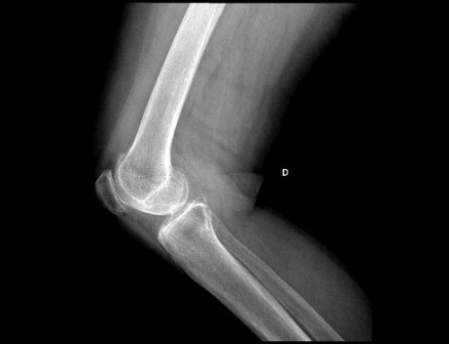 Osteopatía y degeneración ósea (Artrosis)