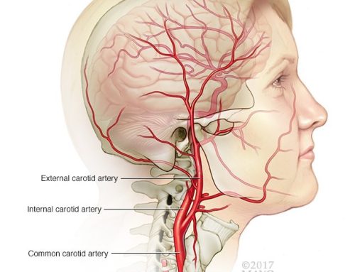 Aneurisma y Osteopatía